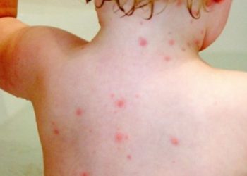 Έξαρση ιλαράς στην Ευρώπη: Τι πρέπει να προσέξουν οι γονείς